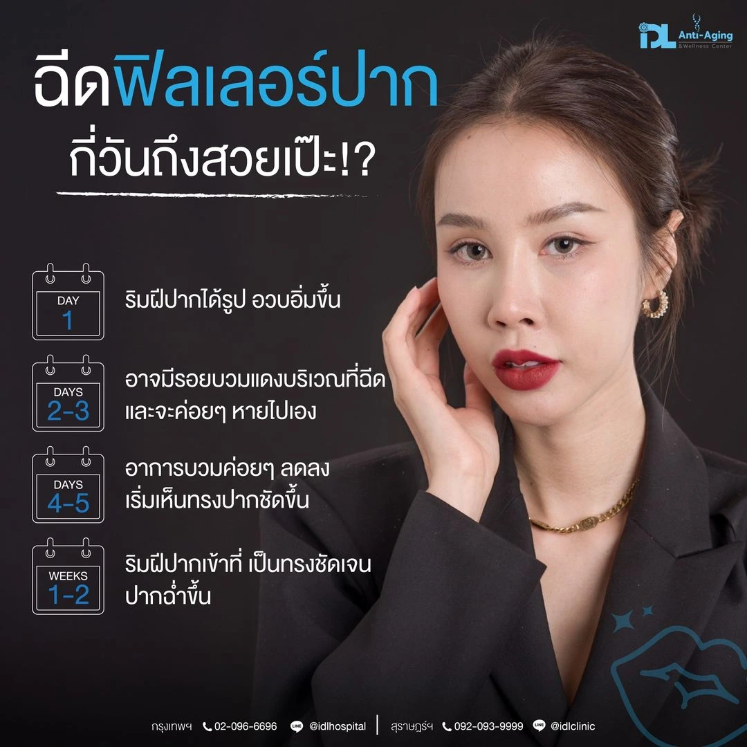 ฟิลเลอร์ปาก บวมกี่วัน
