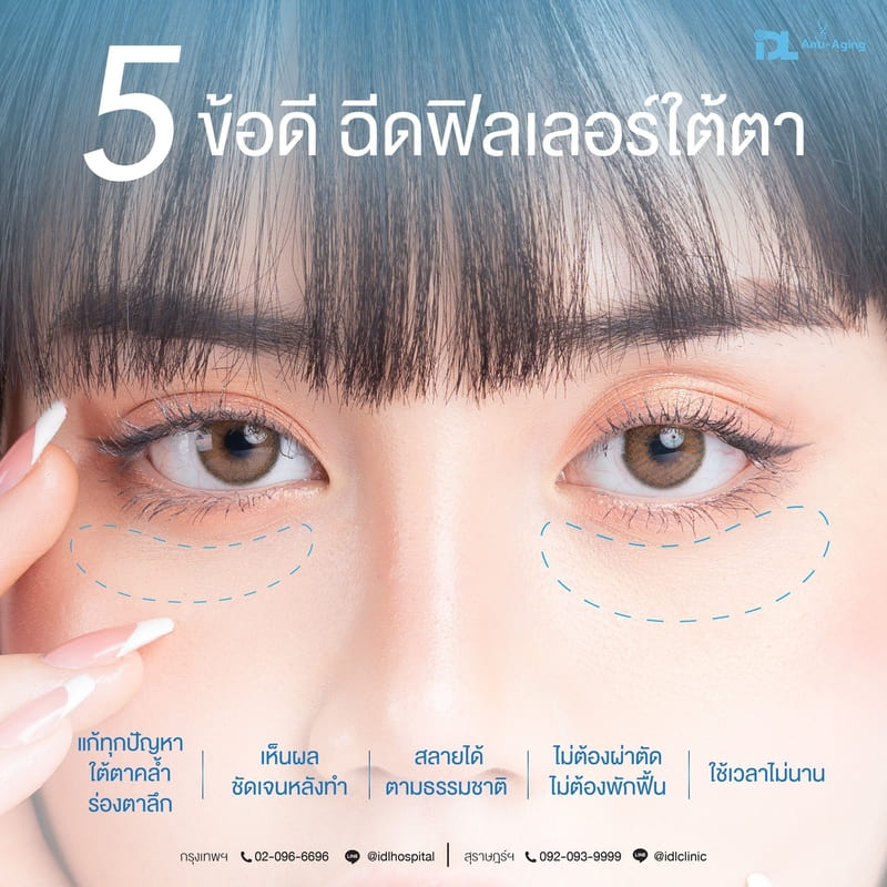 5 ข้อดี ฉีดฟิลเลอร์ใต้ตา IDL