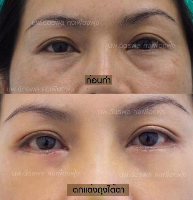 ตัดถุงใต้ตา