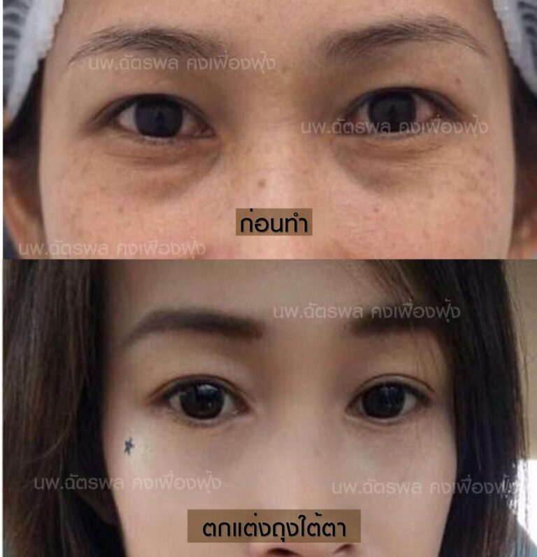 ตัดถุงใต้ตา