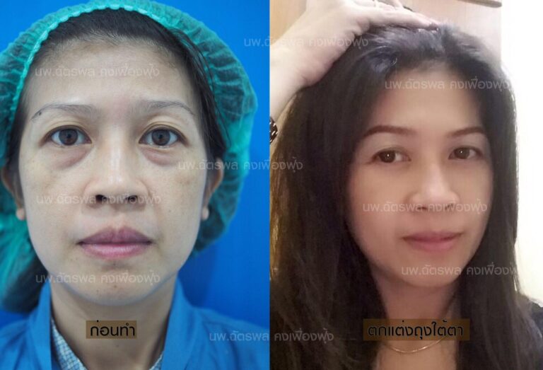 ตัดถุงใต้ตา