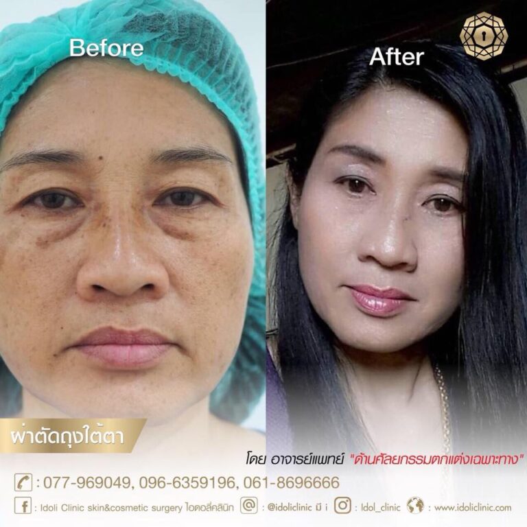 ตัดถุงใต้ตา