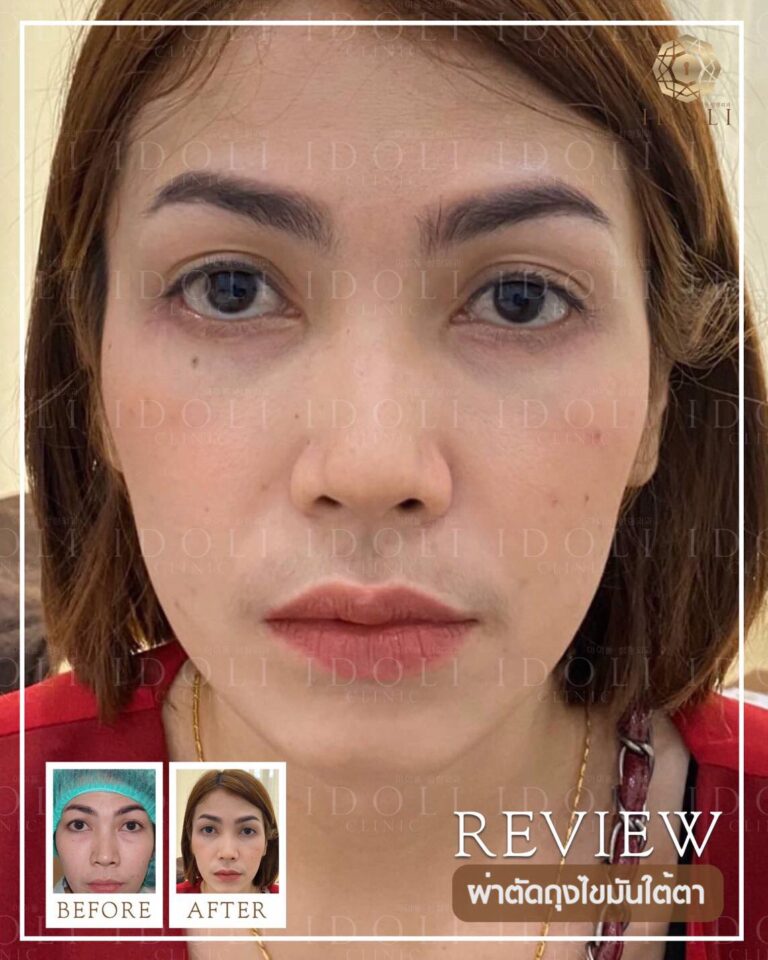 ตัดถุงใต้ตา