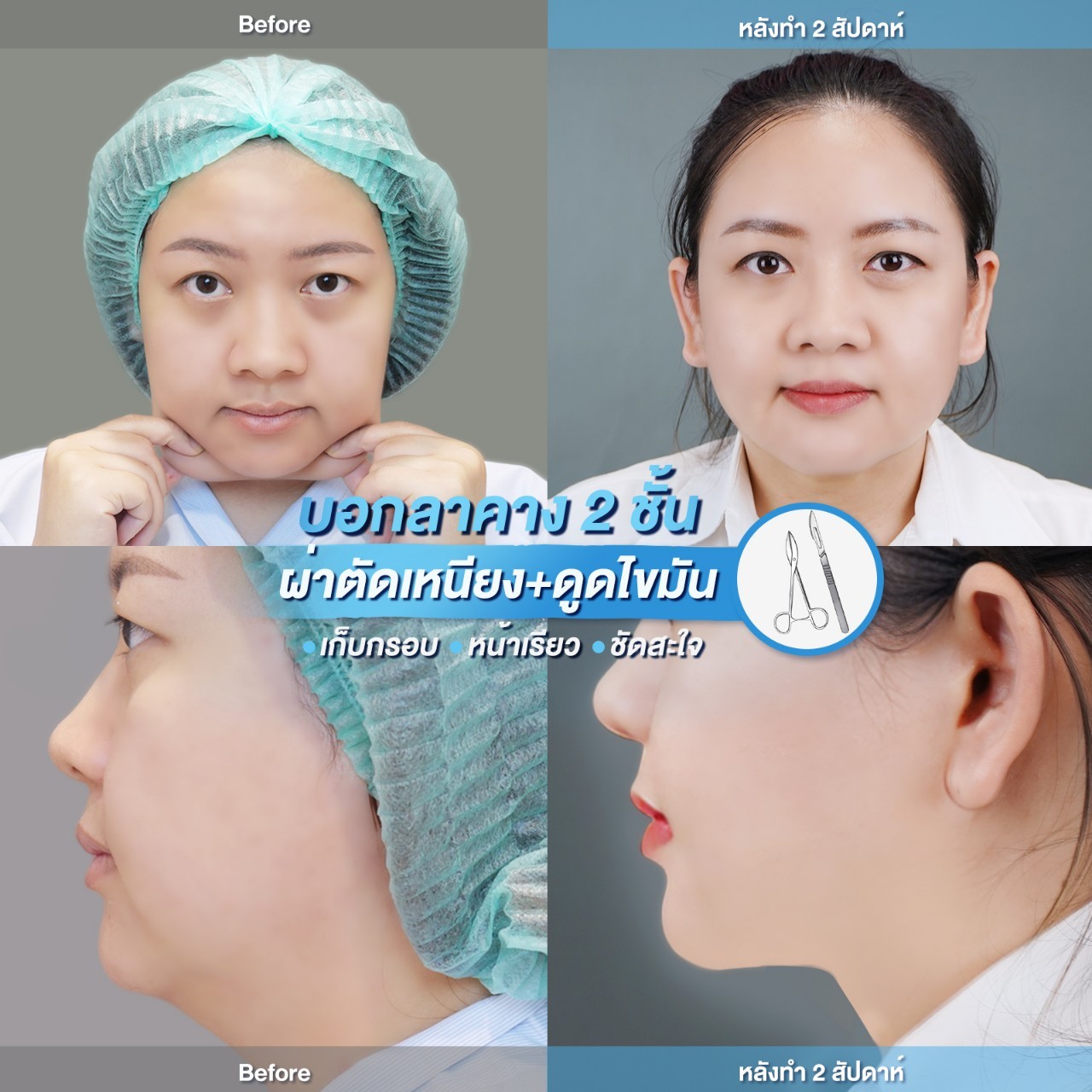 LINE_ALBUM_รีวิวตัดเหนียง​ [หมอแนน]​_231216_1