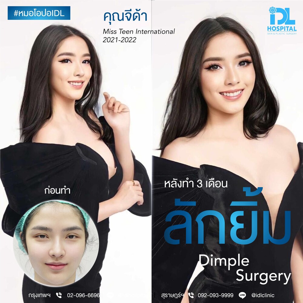 ลักยิ้ม