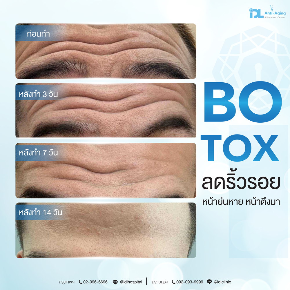 Botox ลดริ้วรอย