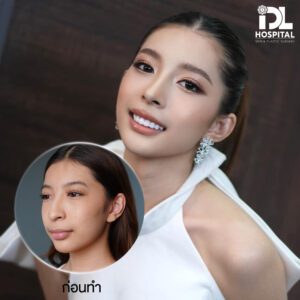 จมูก open