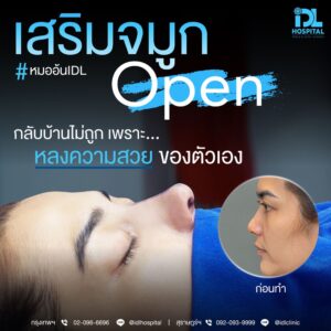 จมูก open