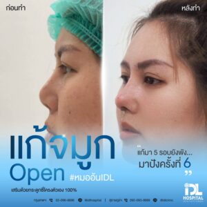 จมูก open