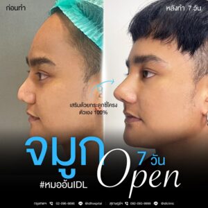 เสริมจมูกผู้ชายกับ