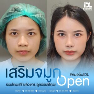 จมูก open