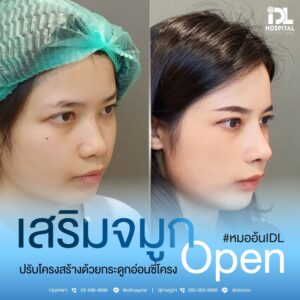 จมูก open
