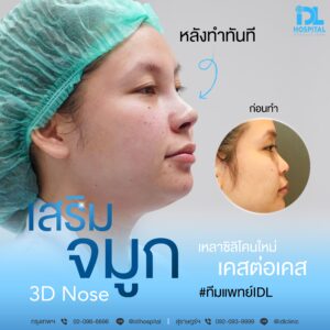 3D nose