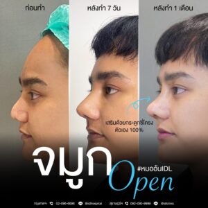 จมูก open
