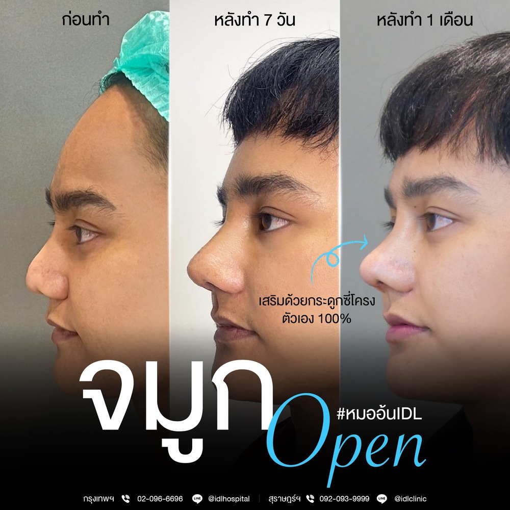 จมูก open