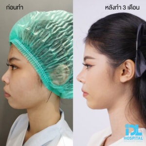 3D nose
