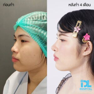 3D nose