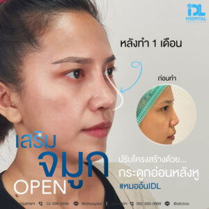 จมูก open