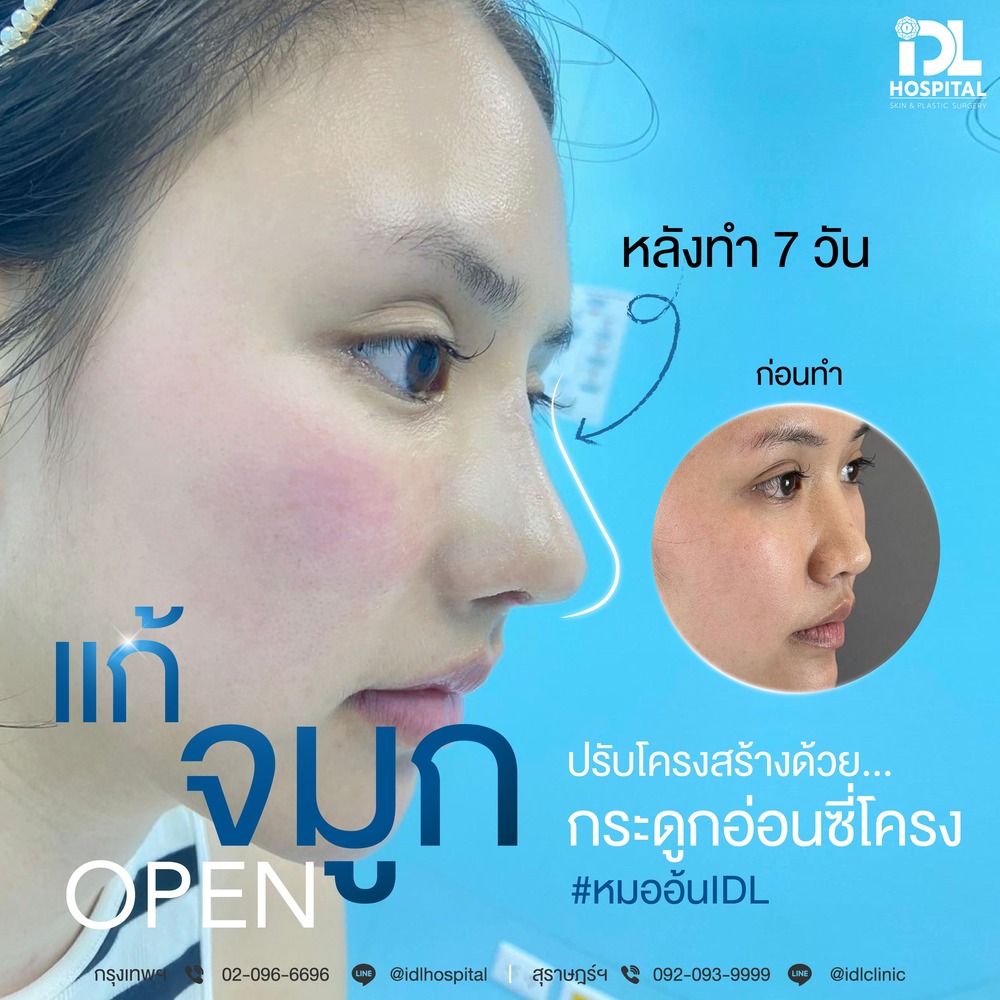 จมูก open