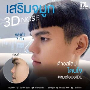 3D nose