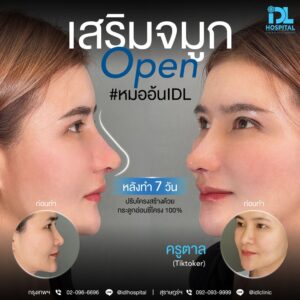จมูก open