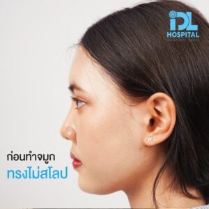 review เสริมหน้าผาก คุณมิว-02