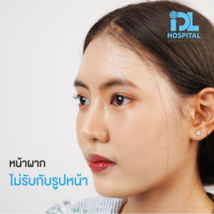 review เสริมหน้าผาก คุณมิว-03