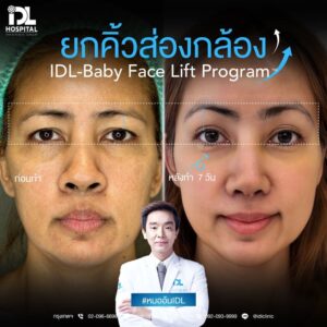 ยกคิ้วส่องกล้อง IDL