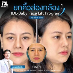 ยกคิ้วส่องกล้อง IDL