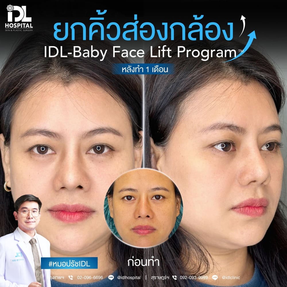 ยกคิ้วส่องกล้อง IDL