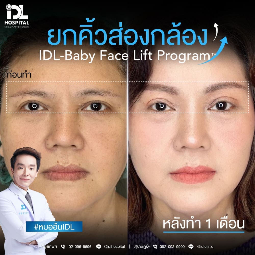 ยกคิ้วส่องกล้อง IDL
