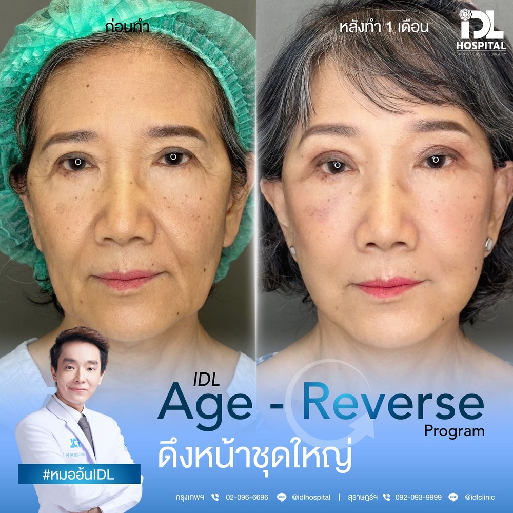 รีวิว ดึงหน้า