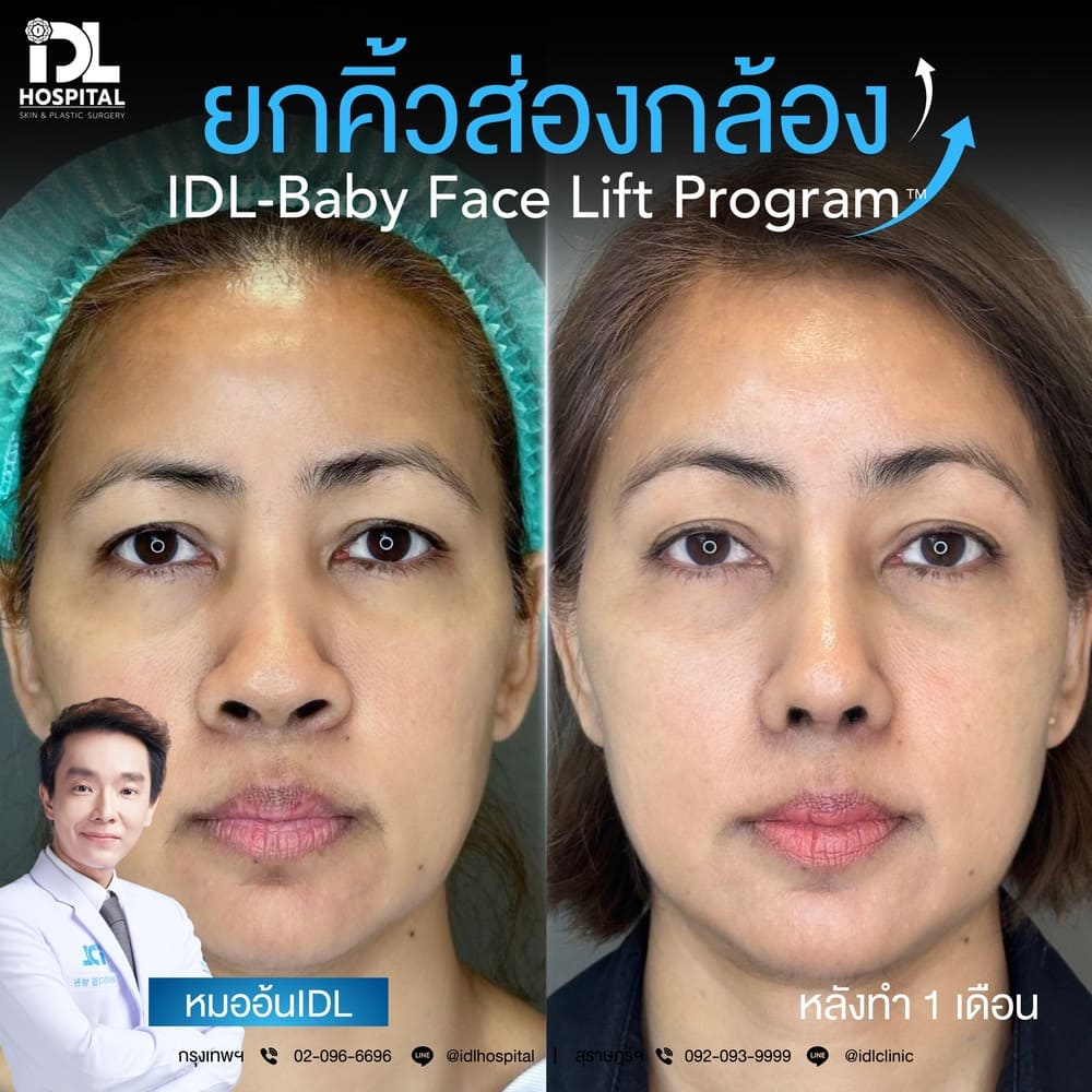 ยกคิ้วส่องกล้อง IDL