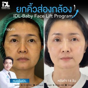 ยกคิ้วส่องกล้อง IDL