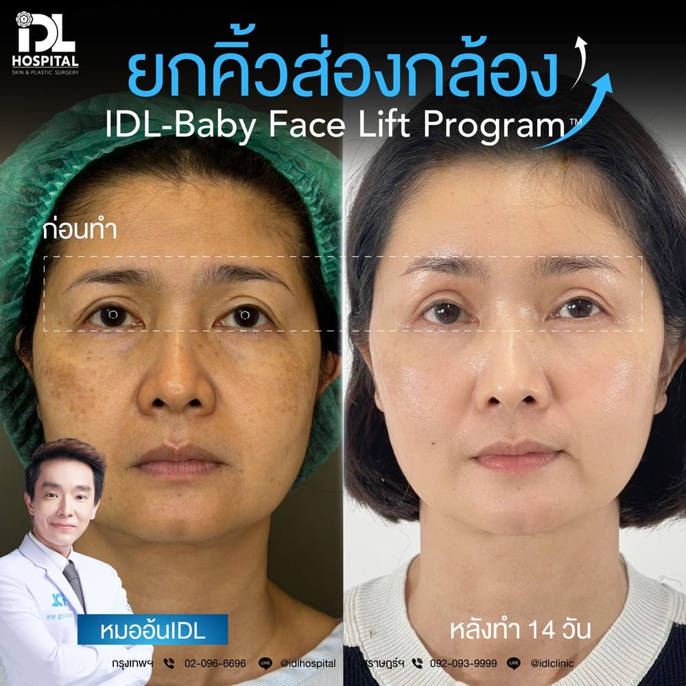 ยกคิ้วส่องกล้อง IDL