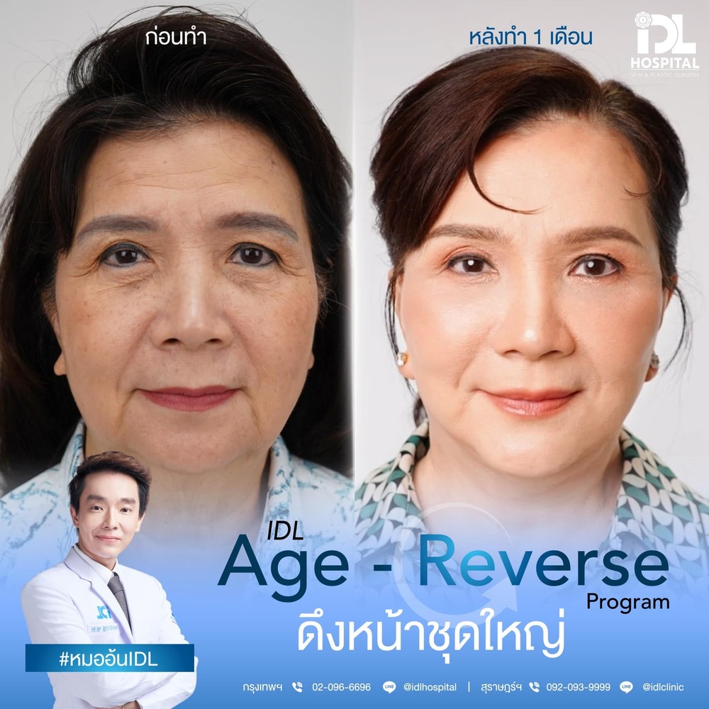 รีวิว ดึงหน้า