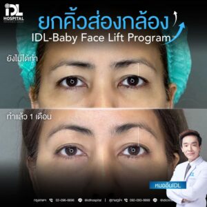 ยกคิ้วส่องกล้อง IDL