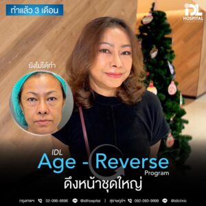 รีวิว ดึงหน้า