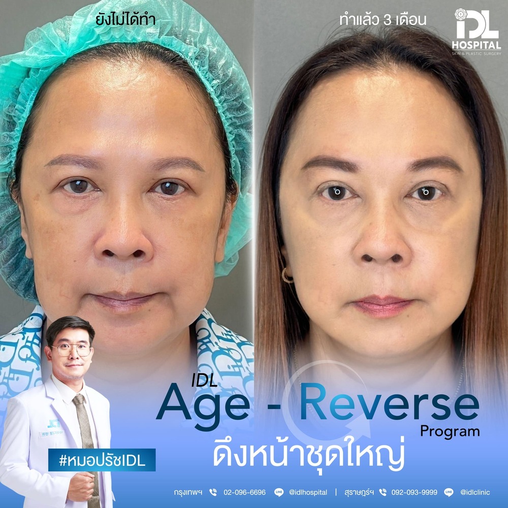 รีวิว ดึงหน้า
