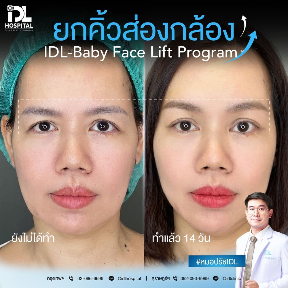 ยกคิ้วส่องกล้อง IDL