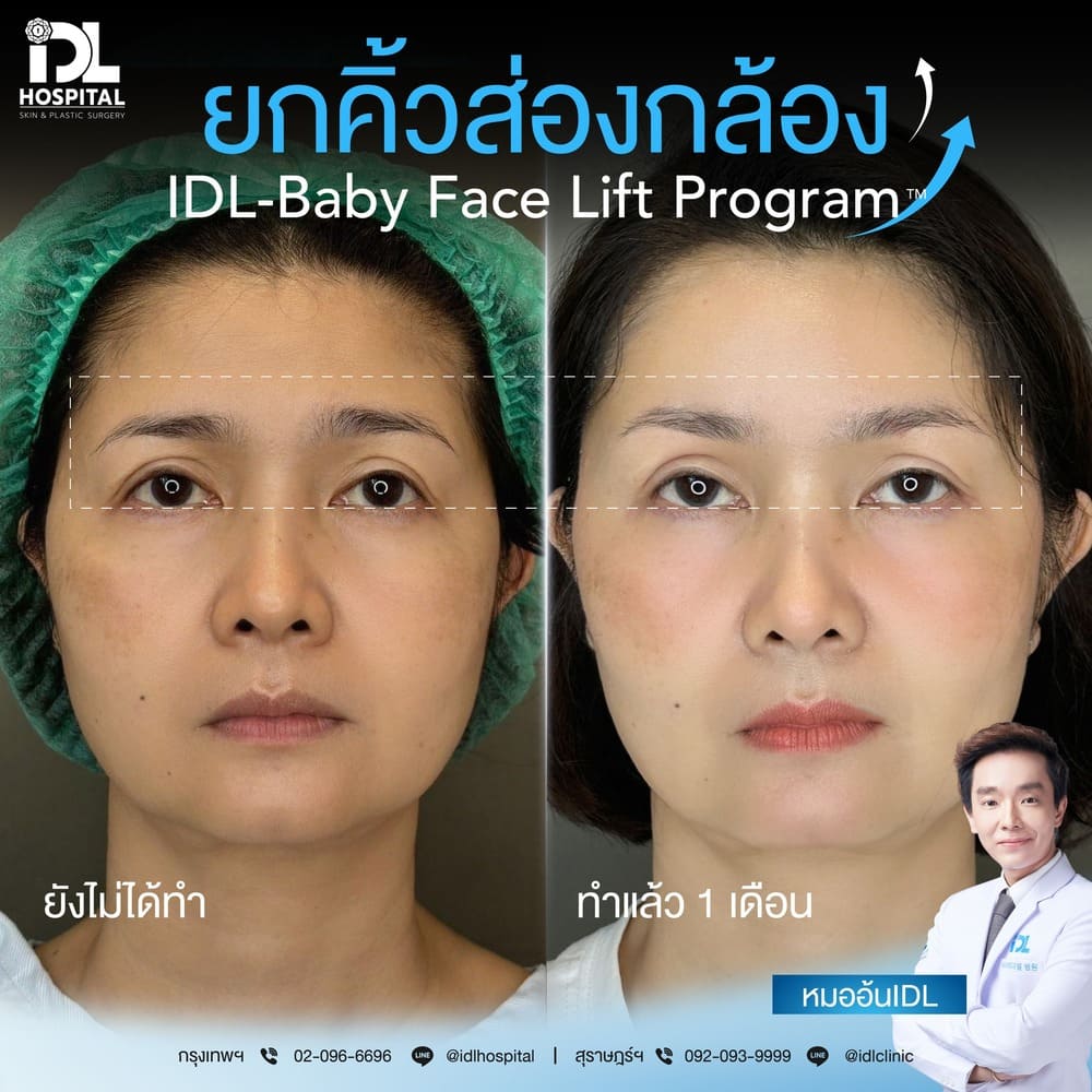 ยกคิ้วส่องกล้อง IDL