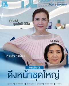 รีวิว ดึงหน้า