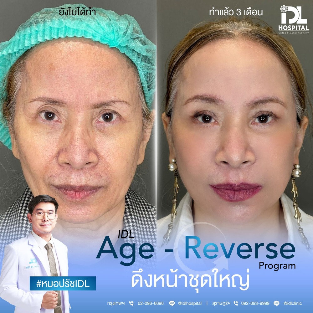 รีวิว ดึงหน้า