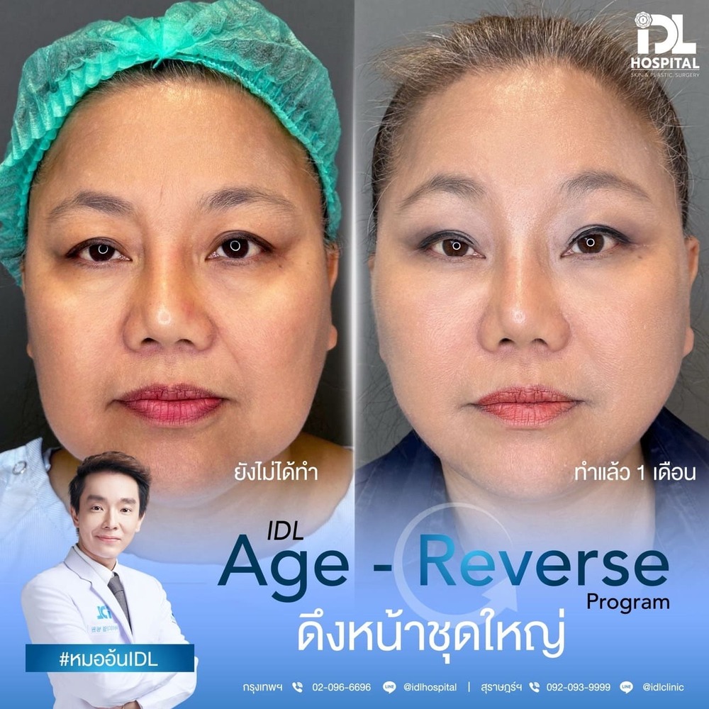 รีวิว ดึงหน้า