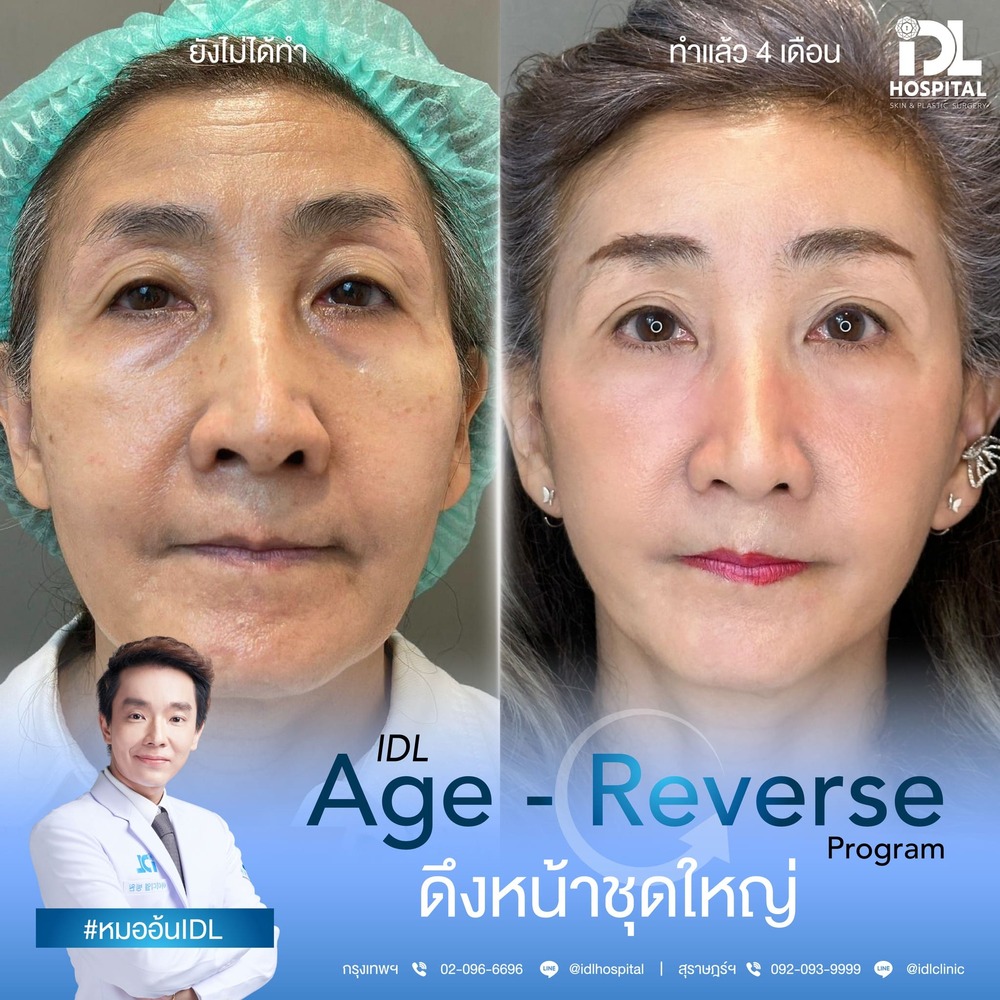รีวิว ดึงหน้า
