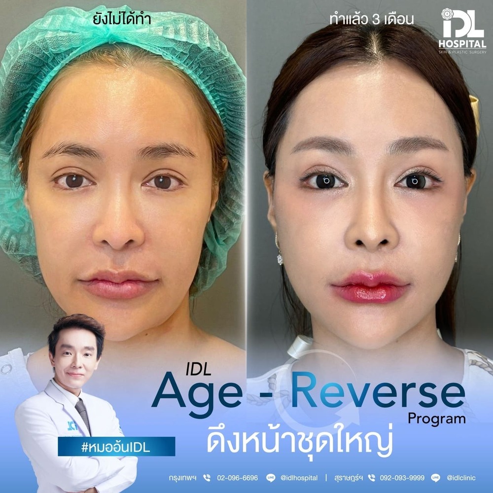 รีวิว ดึงหน้า