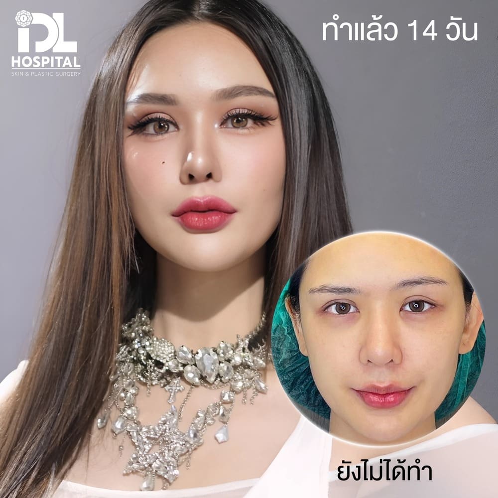 ยกคิ้วส่องกล้อง IDL