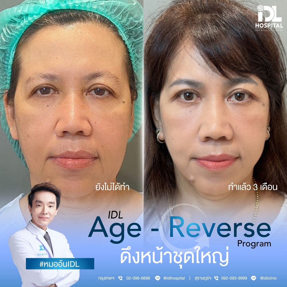 รีวิว ดึงหน้า