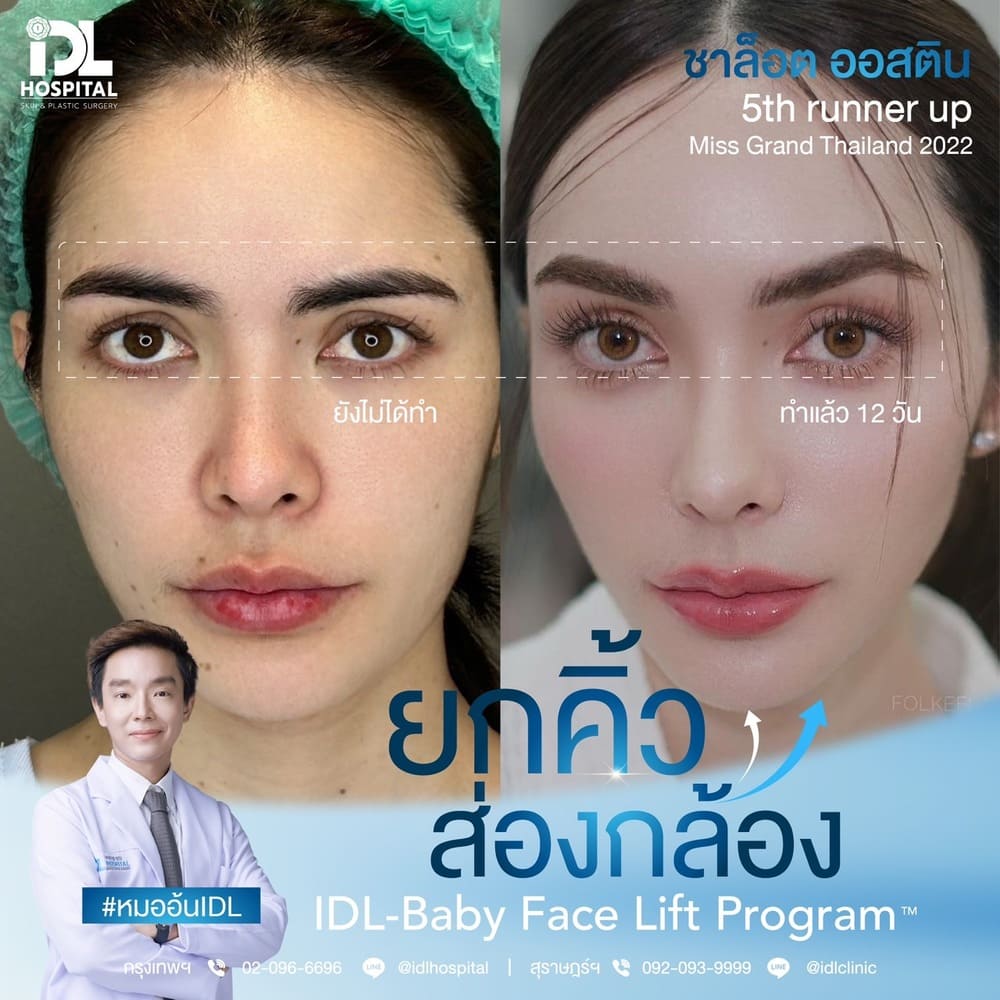 ยกคิ้วส่องกล้อง IDL