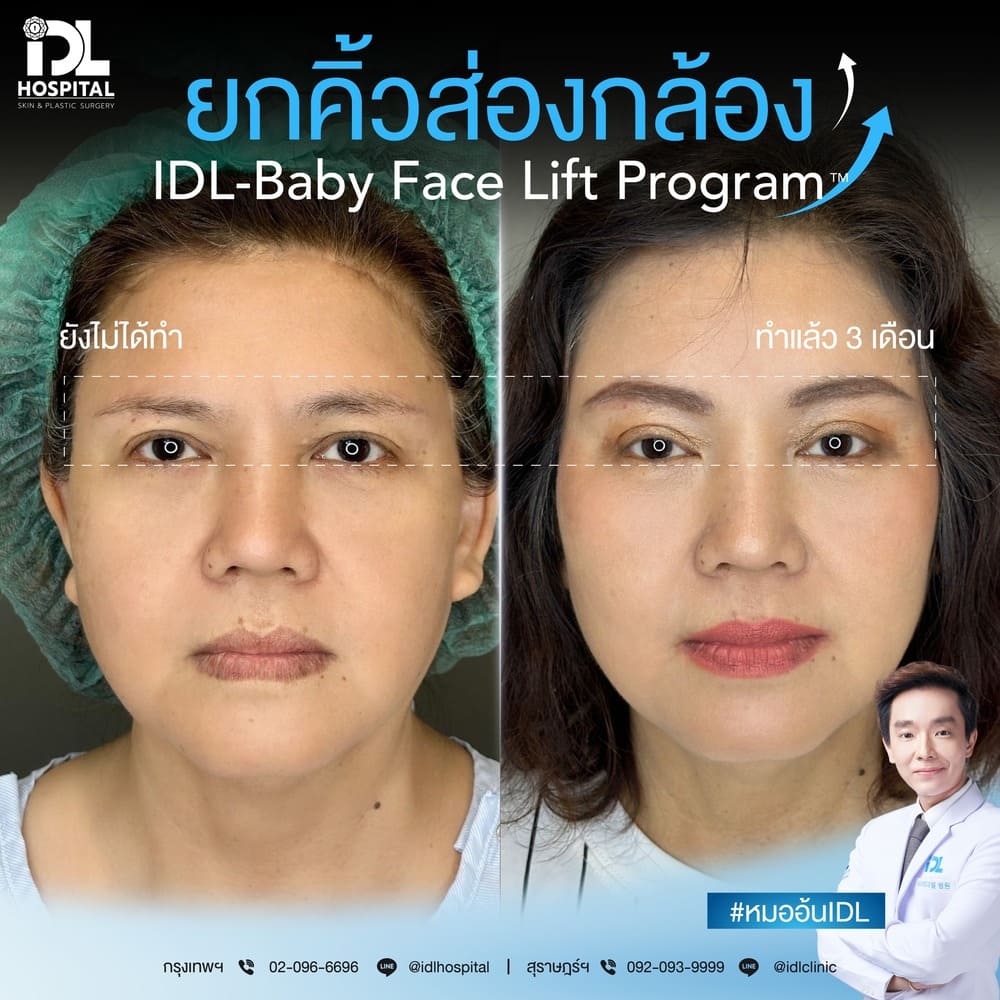 ยกคิ้วส่องกล้อง IDL